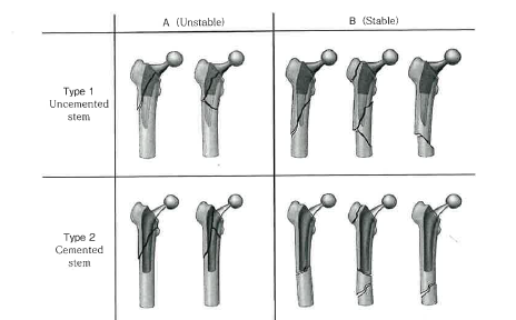 分類】大腿骨ステム周囲骨折 Vancouver分類とBaba分類 | オシゴト整形 ...
